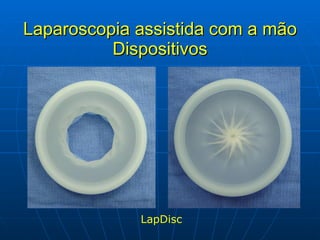 Laparoscopia assistida com a mão Dispositivos LapDisc 