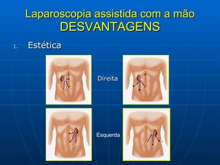 Laparoscopia assistida com a mão DESVANTAGENS Estética Direita Esquerda 