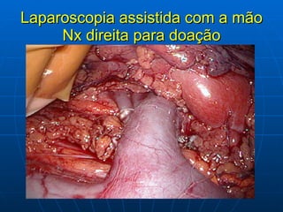 Laparoscopia assistida com a mão Nx direita para doação 