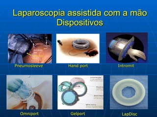 Laparoscopia assistida com a mão Dispositivos Pneumosleeve Hand port Intromit Omniport Gelport LapDisc 