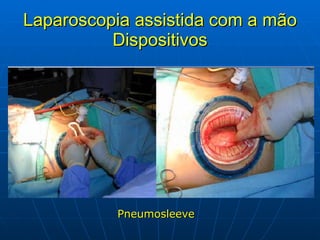 Laparoscopia assistida com a mão Dispositivos Pneumosleeve 