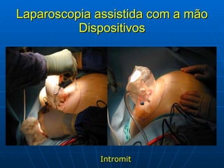 Laparoscopia assistida com a mão Dispositivos Intromit 