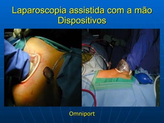 Laparoscopia assistida com a mão Dispositivos Omniport 