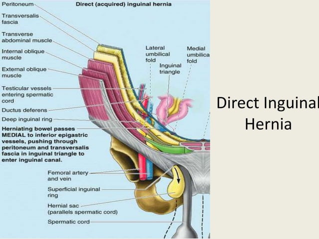Laparoscopic Inguinal Hernia Repair TAPP PPTX Laparoscopic Inguinal Hernia Repair TAPP PPTX