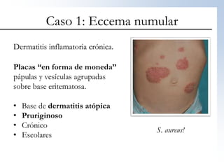 Forma Numular La piel en urgencias. Un trivial dermatológico | PPTX