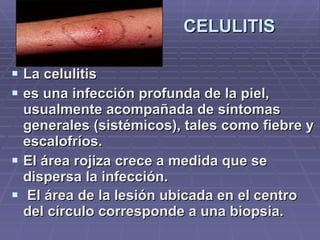 CELULITIS La celulitis  es una infección profunda de la piel, usualmente acompañada de síntomas generales (sistémicos), tales como fiebre y escalofríos.  El área rojiza crece a medida que se dispersa la infección. El área de la lesión ubicada en el centro del círculo corresponde a una biopsia.   