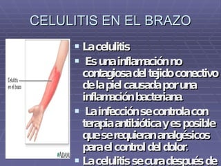 CELULITIS EN EL BRAZO La celulitis Es una inflamación no contagiosa del tejido conectivo de la piel causada por una inflamación bacteriana. La infección se controla con terapia antibiótica y es posible que se requieran analgésicos para el control del dolor.  La celulitis se cura después de siete a diez días de tratamiento.   