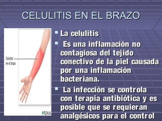 CELULITIS EN EL BRAZO
      La celulitis
      Es una inflamación no
      contagiosa del tejido
      conectivo de la piel causada
      por una inflamación
      bacter iana.
      La infección se contr ola
      con ter apia antibiótica y es
      posible que se r equier an
      analgésicos par a el contr ol
 