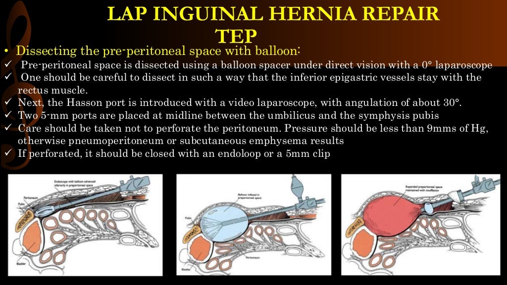 Lap inguinal hernia repair/ operative surgery