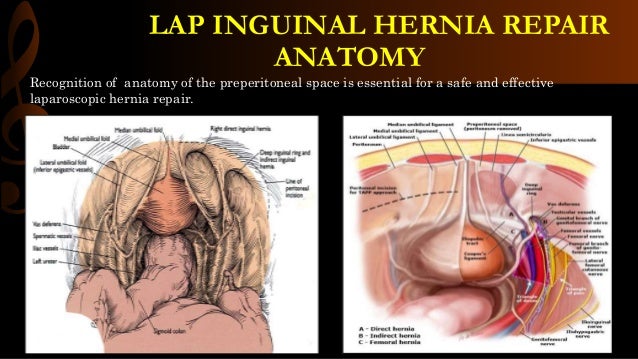 Lap inguinal hernia repair/ operative surgery