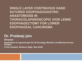 SINGLE LAYER CONTINUOUS HAND
SUTURED ESOPHAGOGASTRIC
ANASTOMOSIS IN
THORACOLAPAROSCOPIC IVOR LEWIS
ESOPHAGECTOMY FOR LOWER
ESOPHAGEAL CARCINOMA
Dr. Pradeep jain
Director
Department of Laparoscopic GI, GI Oncology, Bariatric and Minimal Access
Surgery
Fortis Hospital, Shalimar Bagh, New Delhi
 