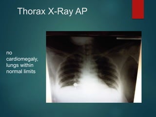 Thorax X-Ray AP
no
cardiomegaly,
lungs within
normal limits
 