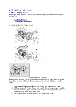 PERSALINAN KEPALA
~ After Coming Head
Pertolongan untuk melahirkan kepala pada presentasi sungsang dapat dilakukan dengan
berbagai cara :
1. Cara MOURICEAU
2. Cara PRAGUE TERBALIK
1. Cara MOURICEAU ( Viet – Smellie)
Gambar 16 Tehnik Mouriceau
Dengan tangan penolong yang sesuai dengan arah menghadapnya muka janin, jari tengah
dimasukkan kedalam mulut janin dan jari telunjuk serta jari manis diletakkan pada fosa
canina.
1. Tubuh anak diletakkan diatas lengan anak, seolah anak “menunggang kuda”.
2. Belakang leher anak dicekap diantara jari telunjuk dan jari tengah tangan yang lain.
3. Assisten membantu dengan melakukan tekanan pada daerah suprasimfisis untuk
mempertahankan posisi fleksi kepala janin.
4. Traksi curam bawah terutama dilakukan oleh tangan yang dileher.
 