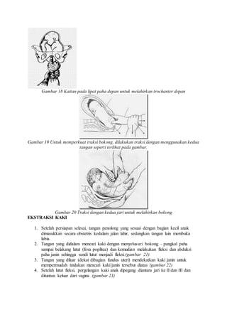 Gambar 18 Kaitan pada lipat paha depan untuk melahirkan trochanter depan
Gambar 19 Untuk memperkuat traksi bokong, dilakukan traksi dengan menggunakan kedua
tangan seperti terlihat pada gambar.
Gambar 20 Traksi dengan kedua jari untuk melahirkan bokong
EKSTRAKSI KAKI
1. Setelah persiapan selesai, tangan penolong yang sesuai dengan bagian kecil anak
dimasukkan secara obstetris kedalam jalan lahir, sedangkan tangan lain membuka
labia.
2. Tangan yang didalam mencari kaki dengan menyelusuri bokong – pangkal paha
sampai belakang lutut (fosa poplitea) dan kemudian melakukan fleksi dan abduksi
paha janin sehingga sendi lutut menjadi fleksi.(gambar 21)
3. Tangan yang diluar (dekat dibagian fundus uteri) mendekatkan kaki janin untuk
mempermudah tindakan mencari kaki janin tersebut diatas (gambar 22)
4. Setelah lutut fleksi, pergelangan kaki anak dipegang diantara jari ke II dan III dan
dituntun keluar dari vagina (gambar 23)
 