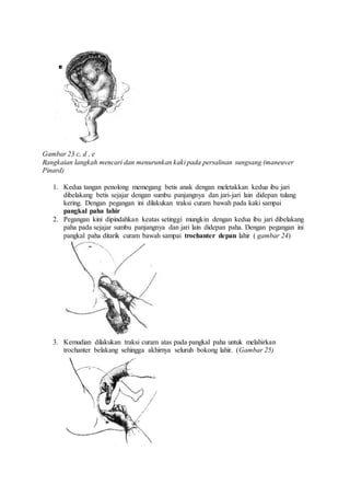 Gambar 23 c, d , e
Rangkaian langkah mencari dan menurunkan kaki pada persalinan sungsang (maneuver
Pinard)
1. Kedua tangan penolong memegang betis anak dengan meletakkan kedua ibu jari
dibelakang betis sejajar dengan sumbu panjangnya dan jari-jari lain didepan tulang
kering. Dengan pegangan ini dilakukan traksi curam bawah pada kaki sampai
pangkal paha lahir
2. Pegangan kini dipindahkan keatas setinggi mungkin dengan kedua ibu jari dibelakang
paha pada sejajar sumbu panjangnya dan jari lain didepan paha. Dengan pegangan ini
pangkal paha ditarik curam bawah sampai trochanter depan lahir ( gambar 24)
3. Kemudian dilakukan traksi curam atas pada pangkal paha untuk melahirkan
trochanter belakang sehingga akhirnya seluruh bokong lahir. (Gambar 25)
 