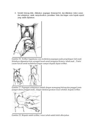 4. Setelah bokong lahir, dilakukan pegangan femuropelvik dan dilakukan traksi curam
dan selanjutnya untuk menyelesaikan persalinan bahu dan lengan serta kepala seperti
yang sudah dijelaskan.
Gambar 26. Terlihat bagaimana cara melakukan pegangan pada pergelangan kaki anak.
Sebaiknya digunakan kain setengah basah untuk mengatasi licinnya tubuh anak ; Traksi
curam bawah untuk melahirkan lengan sampai skapula depan terlihat .
Gambar 27. Pegangan selanjutnya adalah dengan memegang bokong dan panggul janin
(jangan diatas panggul anak). Jangan lakukan gerakan rotasi sebelum skapula terlihat.
Gambar 28. Skapula sudah terlihat, rotasi tubuh sudah boleh dikerjakan
 