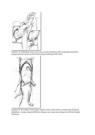Gambar 29. Dilakukan traksi curam atas untuk melahirkan bahu belakang yang diikuti
dengan gerakan untuk membebaskan lengan belakang lebih lanjut.
Gambar 30. Persalinan bahu depan melalui traksi curam bahwa setelah bahu belakang
dilahirkan ; Lengan depan dilahirkan dengan cara yang sama dengan melahirkan lengan
belakang.
 