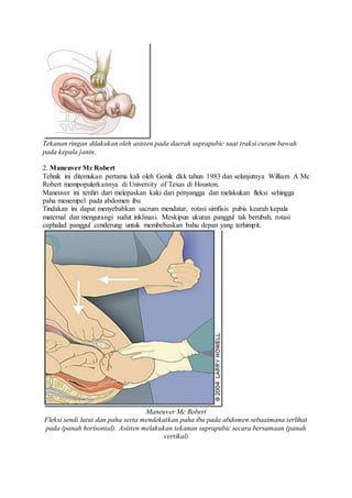 Tekanan ringan dilakukan oleh asisten pada daerah suprapubic saat traksi curam bawah
pada kepala janin.
2. Maneuver Mc Robert
Tehnik ini ditemukan pertama kali oleh Gonik dkk tahun 1983 dan selanjutnya William A Mc
Robert mempopulerkannya di University of Texas di Houston.
Maneuver ini terdiri dari melepaskan kaki dari penyangga dan melakukan fleksi sehingga
paha menempel pada abdomen ibu
Tindakan ini dapat menyebabkan sacrum mendatar, rotasi simfisis pubis kearah kepala
maternal dan mengurangi sudut inklinasi. Meskipun ukuran panggul tak berubah, rotasi
cephalad panggul cenderung untuk membebaskan bahu depan yang terhimpit.
Maneuver Mc Robert
Fleksi sendi lutut dan paha serta mendekatkan paha ibu pada abdomen sebaaimana terlihat
pada (panah horisontal). Asisten melakukan tekanan suprapubic secara bersamaan (panah
vertikal)
 