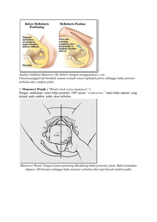 Analisa tindakan Maneuver Mc Robert dengan menggunakan x-ray
Ukuran panggul tak berubah, namun terjadi rotasi cephalad pelvic sehingga bahu anterior
terbebas dari simfisis pubis
3. Maneuver Woods ( “Wood crock screw maneuver” )
Dengan melakukan rotasi bahu posterior 1800 secara “crock screw” maka bahu anterior yang
terjepit pada simfisis pubis akan terbebas.
Maneuver Wood. Tangan kanan penolong dibelakang bahu posterior janin. Bahu kemudian
diputar 180 derajat sehingga bahu anterior terbebas dari tepi bawah simfisis pubis
 