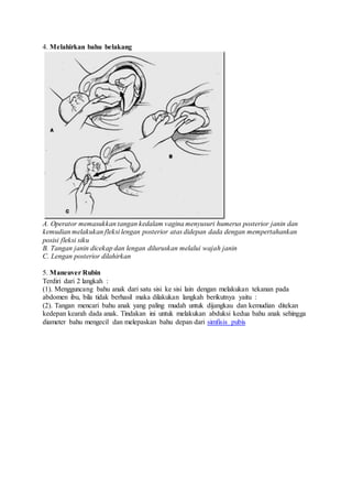 4. Melahirkan bahu belakang
A. Operator memasukkan tangan kedalam vagina menyusuri humerus posterior janin dan
kemudian melakukan fleksi lengan posterior atas didepan dada dengan mempertahankan
posisi fleksi siku
B. Tangan janin dicekap dan lengan diluruskan melalui wajah janin
C. Lengan posterior dilahirkan
5. Maneuver Rubin
Terdiri dari 2 langkah :
(1). Mengguncang bahu anak dari satu sisi ke sisi lain dengan melakukan tekanan pada
abdomen ibu, bila tidak berhasil maka dilakukan langkah berikutnya yaitu :
(2). Tangan mencari bahu anak yang paling mudah untuk dijangkau dan kemudian ditekan
kedepan kearah dada anak. Tindakan ini untuk melakukan abduksi kedua bahu anak sehingga
diameter bahu mengecil dan melepaskan bahu depan dari simfisis pubis
 