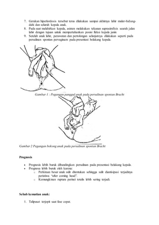7. Gerakan hiperlordosis tersebut terus dilakukan sampai akhirnya lahir mulut-hidung-
dahi dan seluruh kepala anak.
8. Pada saat melahirkan kepala, asisten melakukan tekanan suprasimfisis searah jalan
lahir dengan tujuan untuk mempertahankan posisi fleksi kepala janin
9. Setelah anak lahir, perawatan dan pertolongan selanjutnya dilakukan seperti pada
persalinan spontan pervaginam pada presentasi belakang kepala.
Gambar 1 : Pegangan panggul anak pada persalinan spontan Bracht
Gambar 2 Pegangan bokong anak pada persalinan spontan Bracht
Prognosis
 Prognosis lebih buruk dibandingkan persalinan pada presentasi belakang kepala.
 Prognosa lebih buruk oleh karena:
o Perkiraan besar anak sulit ditentukan sehingga sulit diantisipasi terjadinya
peristiwa “after coming head”.
o Kemungkinan ruptura perinei totalis lebih sering terjadi.
Sebab kematian anak:
1. Talipusat terjepit saat fase cepat.
 
