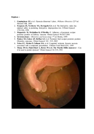Rujukan :
1. Cunningham FG et al : Dystocia-Abnormal Labor , Williams Obstetrics 22nd ed
McGraw Hill, 2005
2. Ferguson JE, Newberry YG, DeAngelis GA et al: The fetal-pelvic index has
minimal utility in predicting fetal-pelvic disproportion.Am J Obstet Gynecol
179;1186, 1998
3. Fitzpatrick M, McQuillan K, O’Herlihy C : Influence of persistent occiput
posterior position on delivery outcome. Obstet Gynecol 98:1027,2001
4. Llewelyn-Jones : Obstetrics and Gynecology 7th ed. Mosby, 1999
5. Ponkey SE, Cohen AP, Heffner LJ et al: Persistent fetal occiput posterior position:
Obstetrics outcomes. Obstet Gynecol 101 : 915, 2003
6. Tebes CC, Mehta P, Calhoun DA, et al: Congenital ischemia forearm necrosis
associated with a compound presentation. J Matern Fetal Med 8:281, 1999
7. Thorp JM Jr, Pahel-Short L, Bowes WA Jr; The Mueller Hillis maneuver : Can
it be used to predict dystocia? Obstet Gynecol 82-519, 1993
 