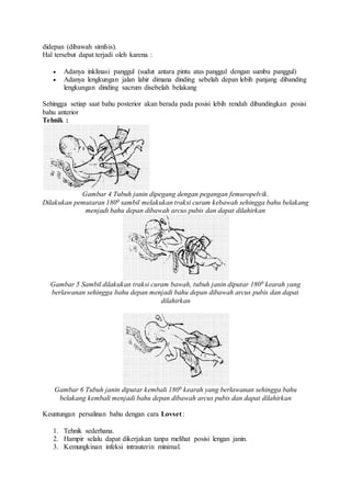 didepan (dibawah simfsis).
Hal tersebut dapat terjadi oleh karena :
 Adanya inklinasi panggul (sudut antara pintu atas panggul dengan sumbu panggul)
 Adanya lengkungan jalan lahir dimana dinding sebelah depan lebih panjang dibanding
lengkungan dinding sacrum disebelah belakang
Sehingga setiap saat bahu posterior akan berada pada posisi lebih rendah dibandingkan posisi
bahu anterior
Tehnik :
Gambar 4 Tubuh janin dipegang dengan pegangan femuropelvik.
Dilakukan pemutaran 1800 sambil melakukan traksi curam kebawah sehingga bahu belakang
menjadi bahu depan dibawah arcus pubis dan dapat dilahirkan
Gambar 5 Sambil dilakukan traksi curam bawah, tubuh janin diputar 1800 kearah yang
berlawanan sehingga bahu depan menjadi bahu depan dibawah arcus pubis dan dapat
dilahirkan
Gambar 6 Tubuh janin diputar kembali 1800 kearah yang berlawanan sehingga bahu
belakang kembali menjadi bahu depan dibawah arcus pubis dan dapat dilahirkan
Keuntungan persalinan bahu dengan cara Lovset :
1. Tehnik sederhana.
2. Hampir selalu dapat dikerjakan tanpa melihat posisi lengan janin.
3. Kemungkinan infeksi intrauterin minimal.
 
