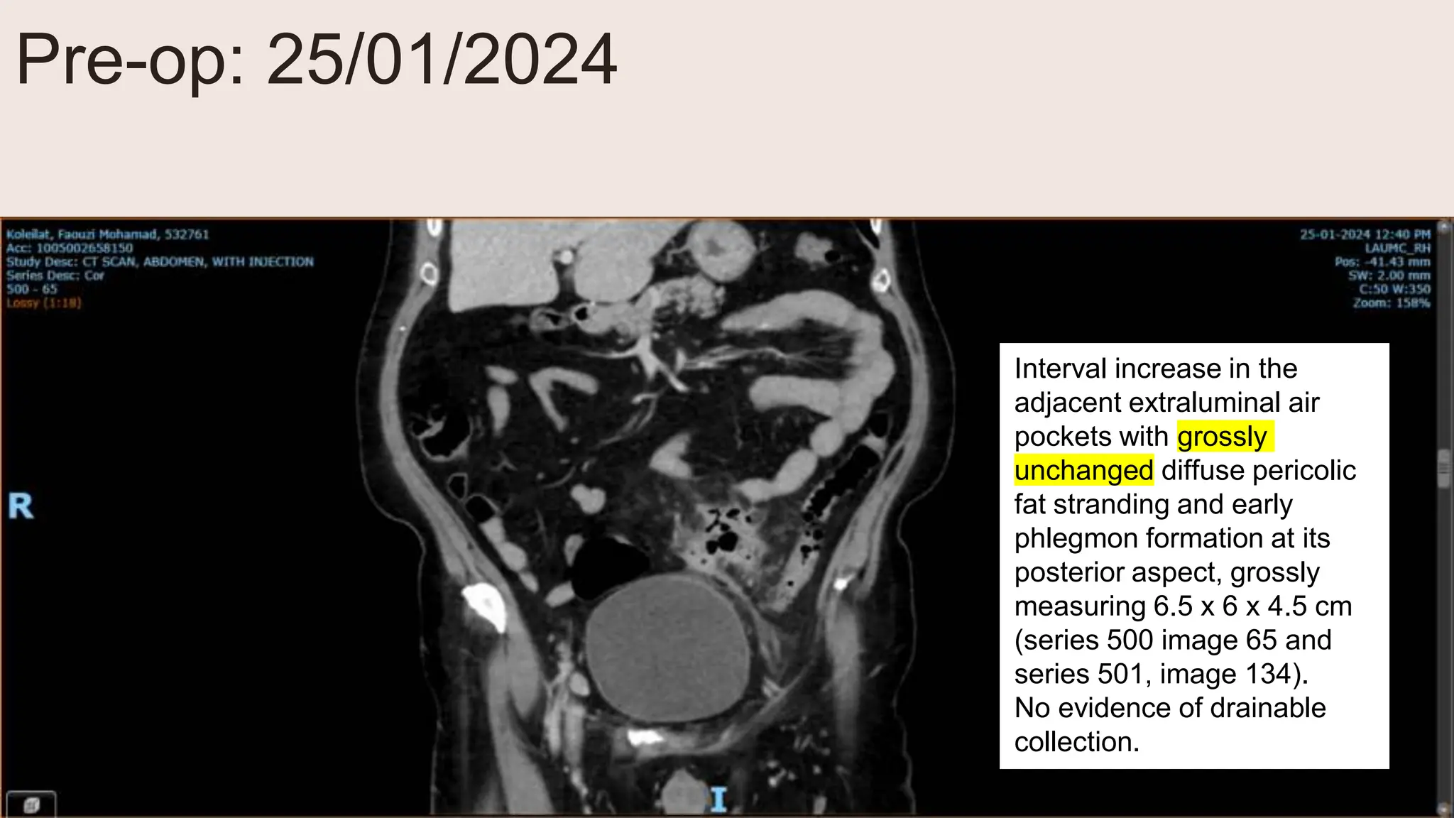 Pre-op: 25/01/2024
Interval increase in the
adjacent extraluminal air
pockets with grossly
unchanged diffuse pericolic
fat stranding and early
phlegmon formation at its
posterior aspect, grossly
measuring 6.5 x 6 x 4.5 cm
(series 500 image 65 and
series 501, image 134).
No evidence of drainable
collection.
 
