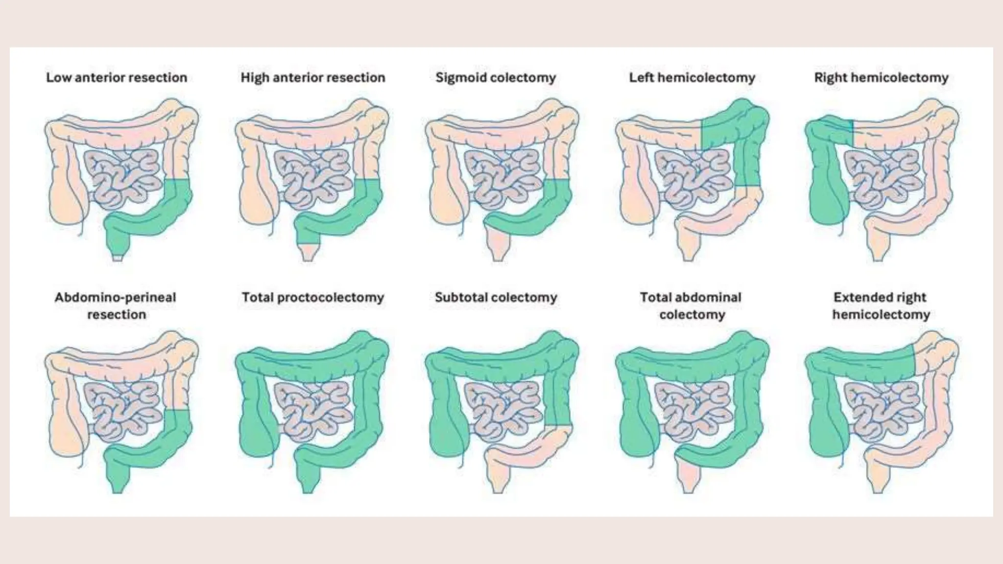 Laparoscopic Low Anterior Resection pptx