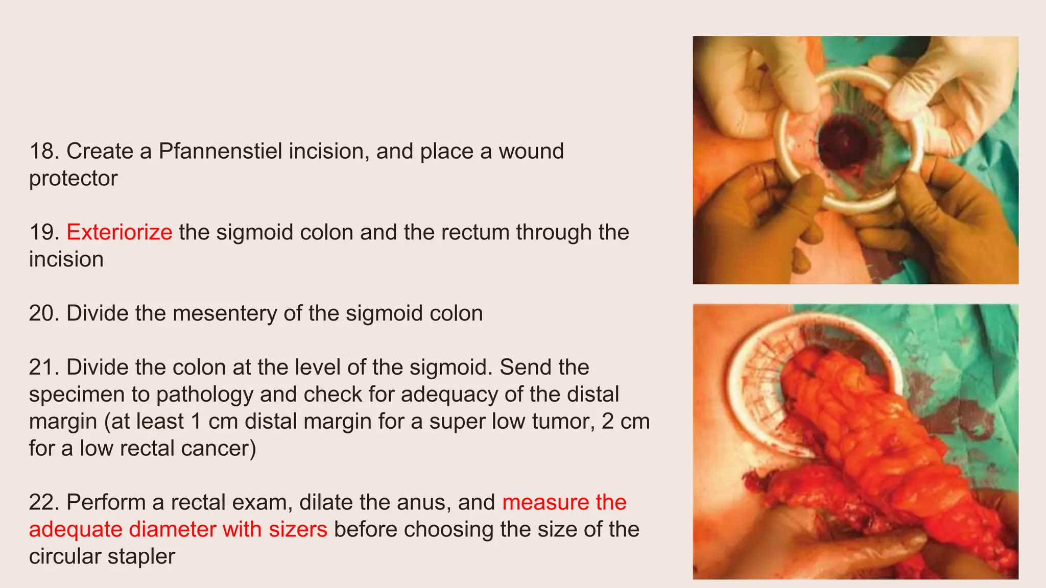 18. Create a Pfannenstiel incision, and place a wound
protector
19. Exteriorize the sigmoid colon and the rectum through the
incision
20. Divide the mesentery of the sigmoid colon
21. Divide the colon at the level of the sigmoid. Send the
specimen to pathology and check for adequacy of the distal
margin (at least 1 cm distal margin for a super low tumor, 2 cm
for a low rectal cancer)
22. Perform a rectal exam, dilate the anus, and measure the
adequate diameter with sizers before choosing the size of the
circular stapler
 