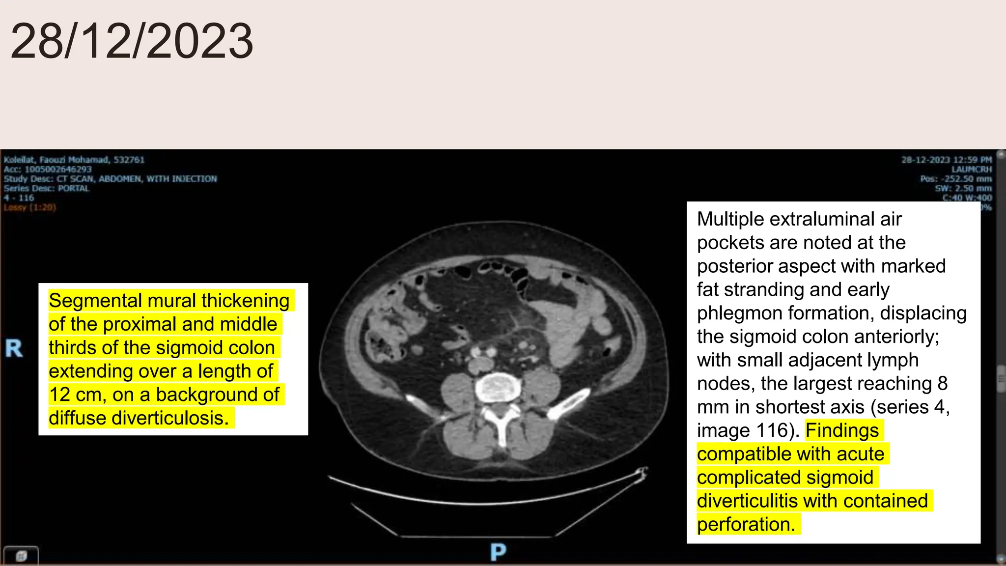 28/12/2023
Segmental mural thickening
of the proximal and middle
thirds of the sigmoid colon
extending over a length of
12 cm, on a background of
diffuse diverticulosis.
Multiple extraluminal air
pockets are noted at the
posterior aspect with marked
fat stranding and early
phlegmon formation, displacing
the sigmoid colon anteriorly;
with small adjacent lymph
nodes, the largest reaching 8
mm in shortest axis (series 4,
image 116). Findings
compatible with acute
complicated sigmoid
diverticulitis with contained
perforation.
 