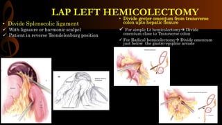 • Divide greter omentum from transverse
colon upto hepatic flexure
 For simple Lt hemicolectomy Divide
omentum close to Transverse colon
 For Radical hemicolectomy Divide omentum
just below the gastro-epiploic arcade
• Divide Splenocolic ligament
 With ligasure or harmonic scalpel
 Patient in reverse Trendelenburg position
LAP LEFT HEMICOLECTOMY
 