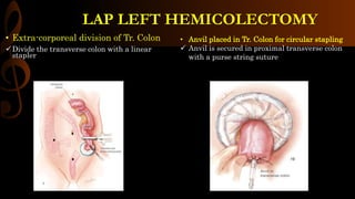 • Extra-corporeal division of Tr. Colon
Divide the transverse colon with a linear
stapler
LAP LEFT HEMICOLECTOMY
• Anvil placed in Tr. Colon for circular stapling
 Anvil is secured in proximal transverse colon
with a purse string suture
 