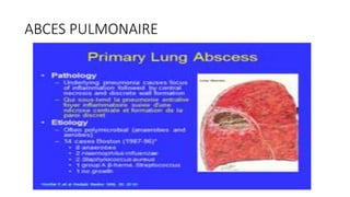 ABCES PULMONAIRE
 