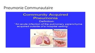 Pneumonie Communautaire
 