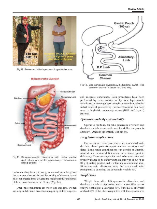 LAPAROSCOPIC SURGERY FOR MORBID OBESITY