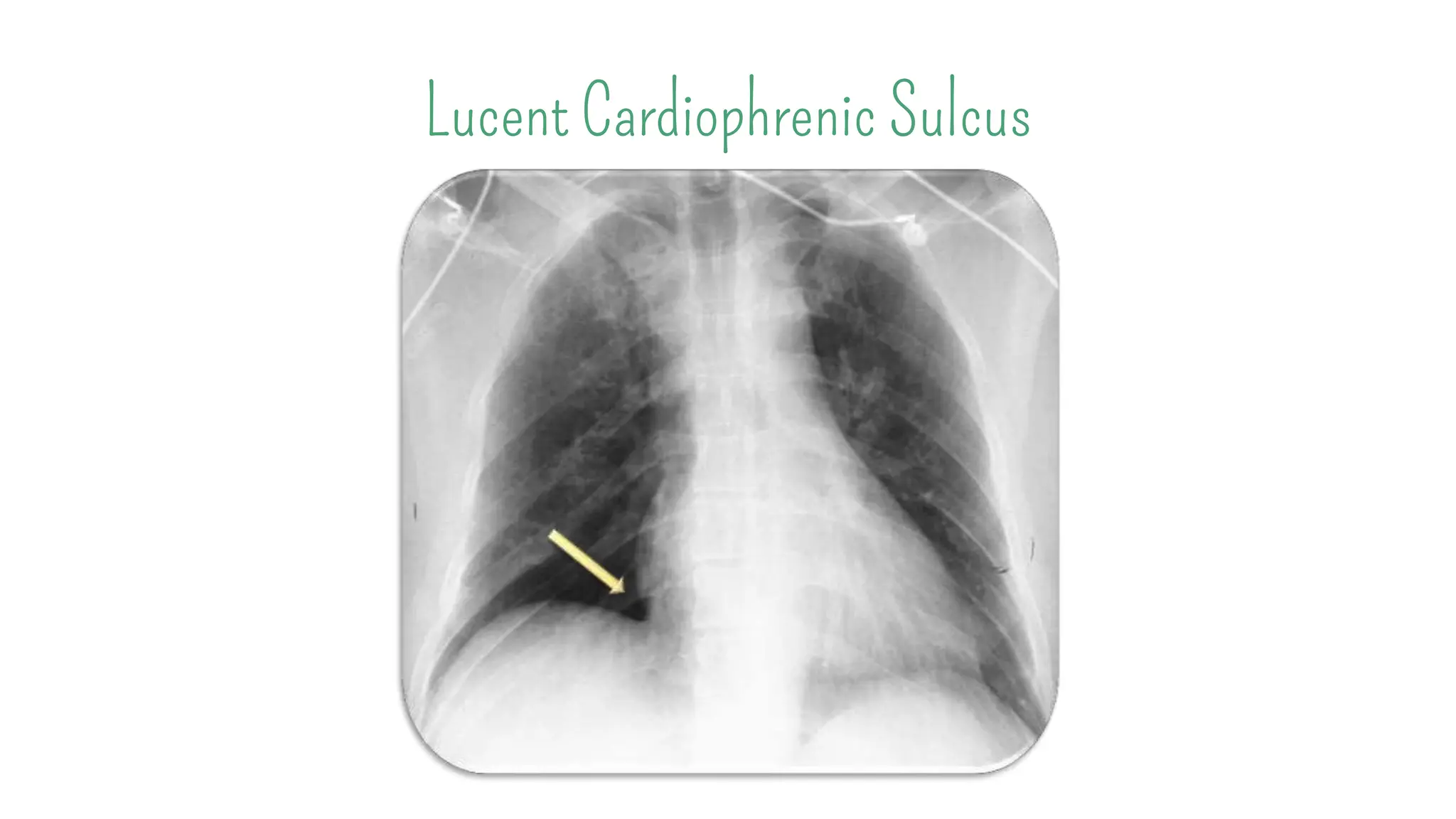 Laporan Kasus - Pneumothorax.pptx