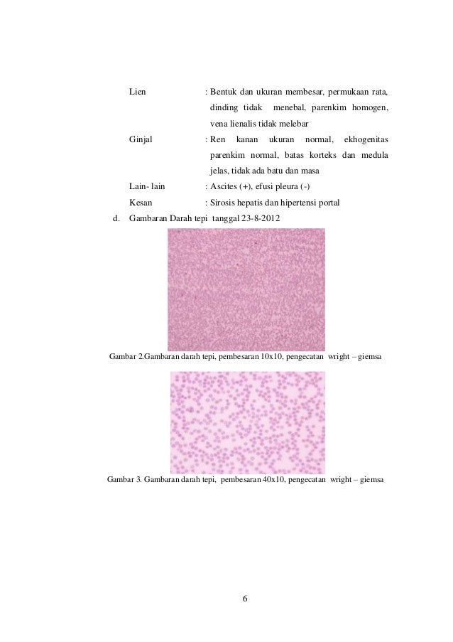 Laporan kasus sirosis hepatis, diana