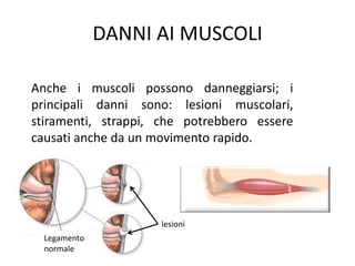 DANNI AI MUSCOLI
Anche i muscoli possono danneggiarsi; i
principali danni sono: lesioni muscolari,
stiramenti, strappi, che potrebbero essere
causati anche da un movimento rapido.
Legamento
normale
lesioni
 
