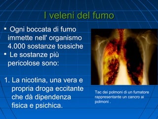 I veleni del fumoI veleni del fumo

Ogni boccata di fumo
immette nell' organismo
4.000 sostanze tossiche

Le sostanze più
pericolose sono:
1. La nicotina, una vera e
propria droga eccitante
che dà dipendenza
fisica e psichica.
Tac dei polmoni di un fumatore
rappresentante un cancro ai
polmoni .
 