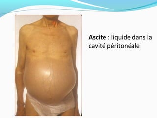Ascite : liquide dans la
cavité péritonéale
 