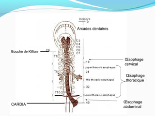 Bouche de Killian
Œsophage
thoracique
Œsophage
abdominal
Œsophage
cervical
Arcades dentaires
CARDIA
 
