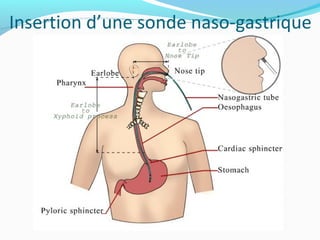 Insertion d’une sonde naso-gastrique
 