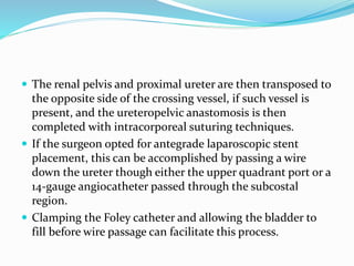  The renal pelvis and proximal ureter are then transposed to
the opposite side of the crossing vessel, if such vessel is
present, and the ureteropelvic anastomosis is then
completed with intracorporeal suturing techniques.
 If the surgeon opted for antegrade laparoscopic stent
placement, this can be accomplished by passing a wire
down the ureter though either the upper quadrant port or a
14-gauge angiocatheter passed through the subcostal
region.
 Clamping the Foley catheter and allowing the bladder to
fill before wire passage can facilitate this process.
 