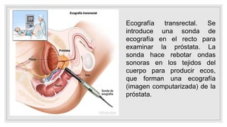 Ecografía transrectal. Se
introduce una sonda de
ecografía en el recto para
examinar la próstata. La
sonda hace rebotar ondas
sonoras en los tejidos del
cuerpo para producir ecos,
que forman una ecografía
(imagen computarizada) de la
próstata.
 