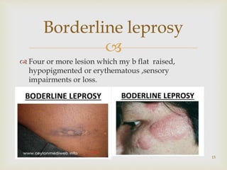 
15
Borderline leprosy
 Four or more lesion which my b flat raised,
hypopigmented or erythematous ,sensory
impairments or loss.
 