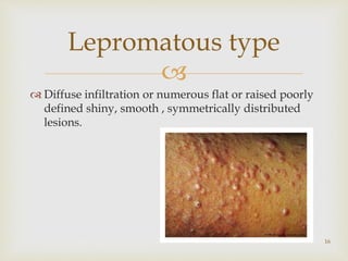 
 Diffuse infiltration or numerous flat or raised poorly
defined shiny, smooth , symmetrically distributed
lesions.
16
Lepromatous type
 