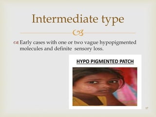 
 Early cases with one or two vague hypopigmented
molecules and definite sensory loss.
17
Intermediate type
 