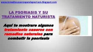 www.remedioscaserosparalapsoriasis.blogspot.com
LA PSORIASIS Y SU
TRATAMIENTO NATURISTA
Aquí te mostrare algunos
tratamiento caseros con
remedios naturales para
combatir la psoriasis
 