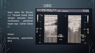 USG
Nyeri tekan Mc Burney
(+), Tampak bowel blind
dengan diameter 9mm
membentuk gambaran
target sign. Cairan bebas
(-)
Kesan:
Menyokong appendicitis
Akut
 